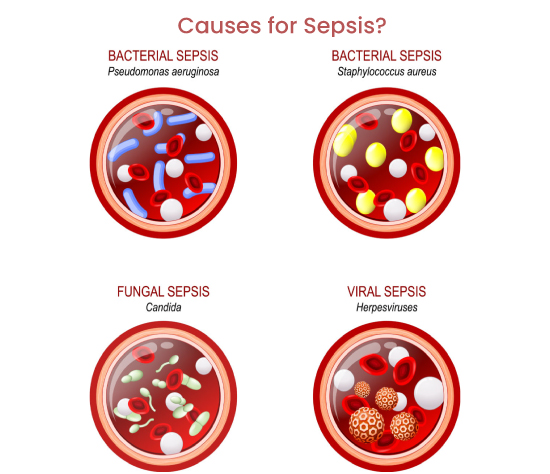 causes for Sepsis