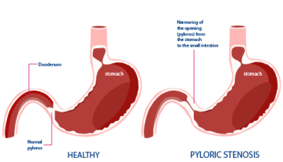 Pyloric Stenosis - Anupama Hospitals