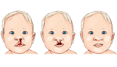 Cleft lip and palate - Anupama Hospitals